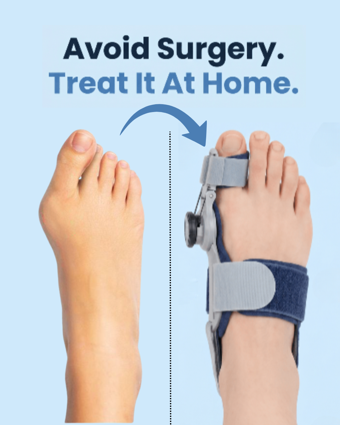 Sleeprelief™ Bunion Corrector Brace